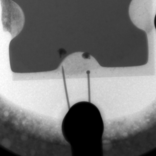X線によるワイヤボンディングの断線画像｜X線非破壊検査装置導入事例｜松定プレシジョン